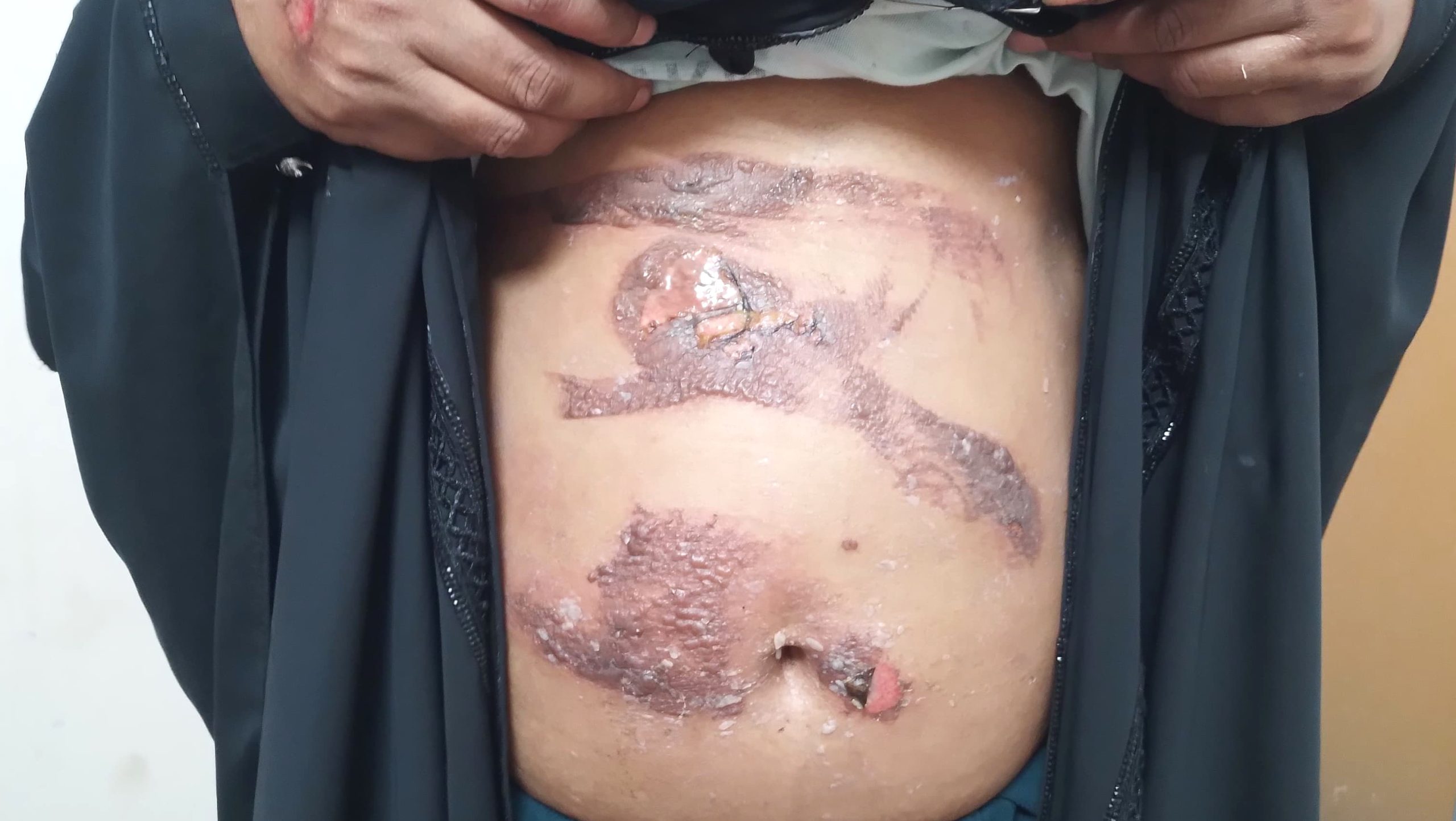 মাটিরাঙ্গায় যৌতুকে আগুন: দগ্ধ স্ত্রী, স্বামী পলাতক